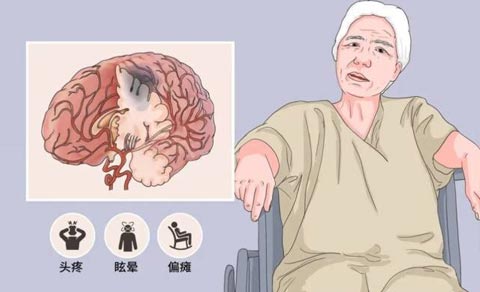 國內已有5款新藥IND獲批，干細胞治療腦卒中的臨床研究進展